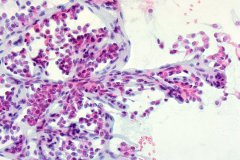 Solid pseudopapillary neoplasm of the pancreas