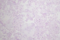 Pancreatic pseudocyst