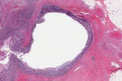 Diverticulitis in the colon