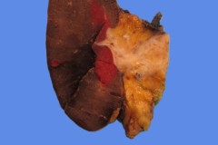 Ductal adenocarcinoma of the pancreas invading the spleen