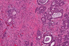 Ductal adenocarcinoma of the pancreas