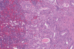 Metastatic ductal adenocarcinoma from the pancreas to a lymph node