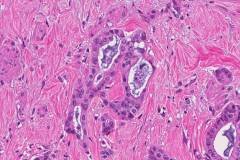 Ductal adenocarcinoma of the pancreas