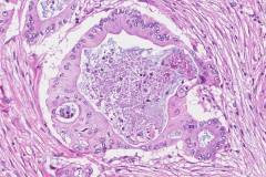 Ductal adenocarcinoma of the pancreas