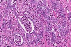 Ductal adenocarcinoma of the pancreas