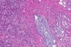 Ductal adenocarcinoma of the pancreas