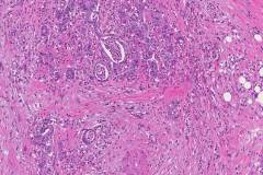 Ductal adenocarcinoma of the pancreas