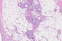 Ductal adenocarcinoma of the pancreas