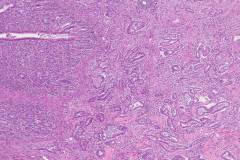 Ductal adenocarcinoma of the pancreas