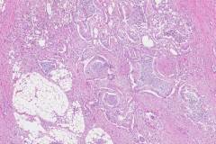 Ductal adenocarcinoma of the pancreas