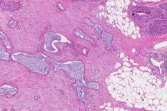 Ductal adenocarcinoma of the pancreas