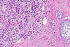 Ductal adenocarcinoma of the pancreas