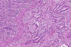 Ductal adenocarcinoma of the pancreas