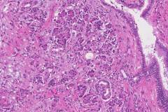 Ductal adenocarcinoma of the pancreas