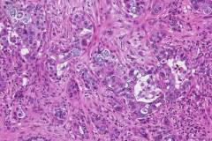 Ductal adenocarcinoma of the pancreas