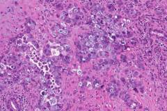 Ductal adenocarcinoma of the pancreas