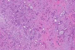 Ductal adenocarcinoma of the pancreas