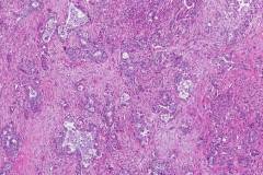 Ductal adenocarcinoma of the pancreas