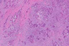 Ductal adenocarcinoma of the pancreas