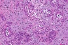 Ductal adenocarcinoma of the pancreas