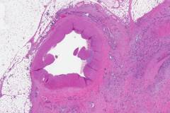 Ductal adenocarcinoma of the pancreas