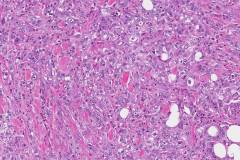 Ductal adenocarcinoma of the pancreas