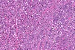 Ductal adenocarcinoma of the pancreas