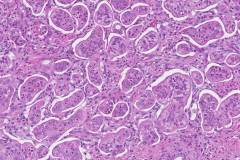 Ductal adenocarcinoma of the pancreas