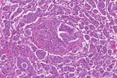 Ductal adenocarcinoma of the pancreas