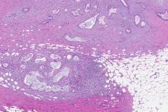 Ductal adenocarcinoma of the pancreas