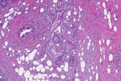 Ductal adenocarcinoma of the pancreas