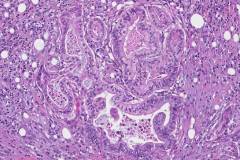 Ductal adenocarcinoma of the pancreas