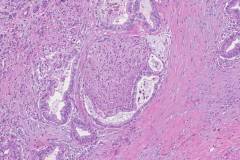 Ductal adenocarcinoma of the pancreas