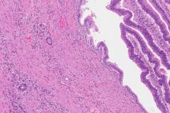 Ductal adenocarcinoma arising from am intraductal papillary mucinous neoplasm of the pancreas