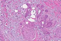 Ductal adenocarcinoma of the pancreas