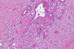 Ductal adenocarcinoma of the pancreas