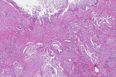 Ductal adenocarcinoma arising from am intraductal papillary mucinous neoplasm of the pancreas