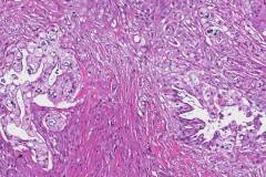 Ductal adenocarcinoma arising from am intraductal papillary mucinous neoplasm of the pancreas