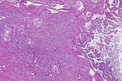 Ductal adenocarcinoma arising from am intraductal papillary mucinous neoplasm of the pancreas