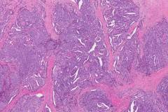 Ductal adenocarcinoma of the prostate gland