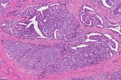 Ductal adenocarcinoma of the prostate gland