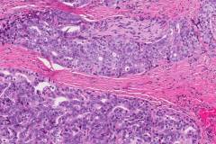 Ductal adenocarcinoma of the prostate gland