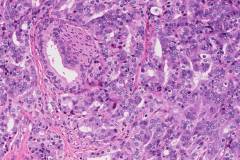 Ductal adenocarcinoma of the prostate gland