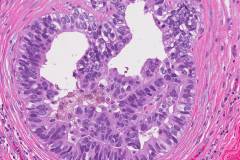 Ductal carcinoma in situ of the breast