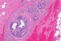 Ductal carcinoma in situ of the breast