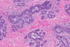 Ductal carcinoma in situ of the breast