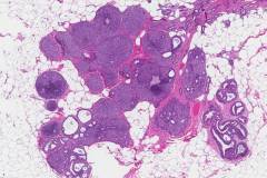 Ductal carcinoma in situ of the breast