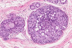 Ductal carcinoma in situ of the breast