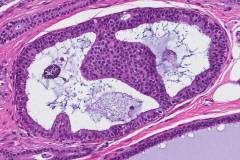 Ductal carcinoma in situ of the breast