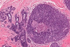 Ductal carcinoma in situ of the breast